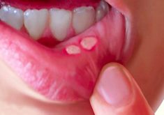 10 ماده طبیعی برای خلاص شدن از شر آفت دهان